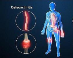 Остеоартроз (остеоартрит): что такое, признаки, фото