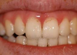 Методы восстановления зубной эмали
